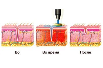 Что происходит при радиоволновой подтяжке кожи?